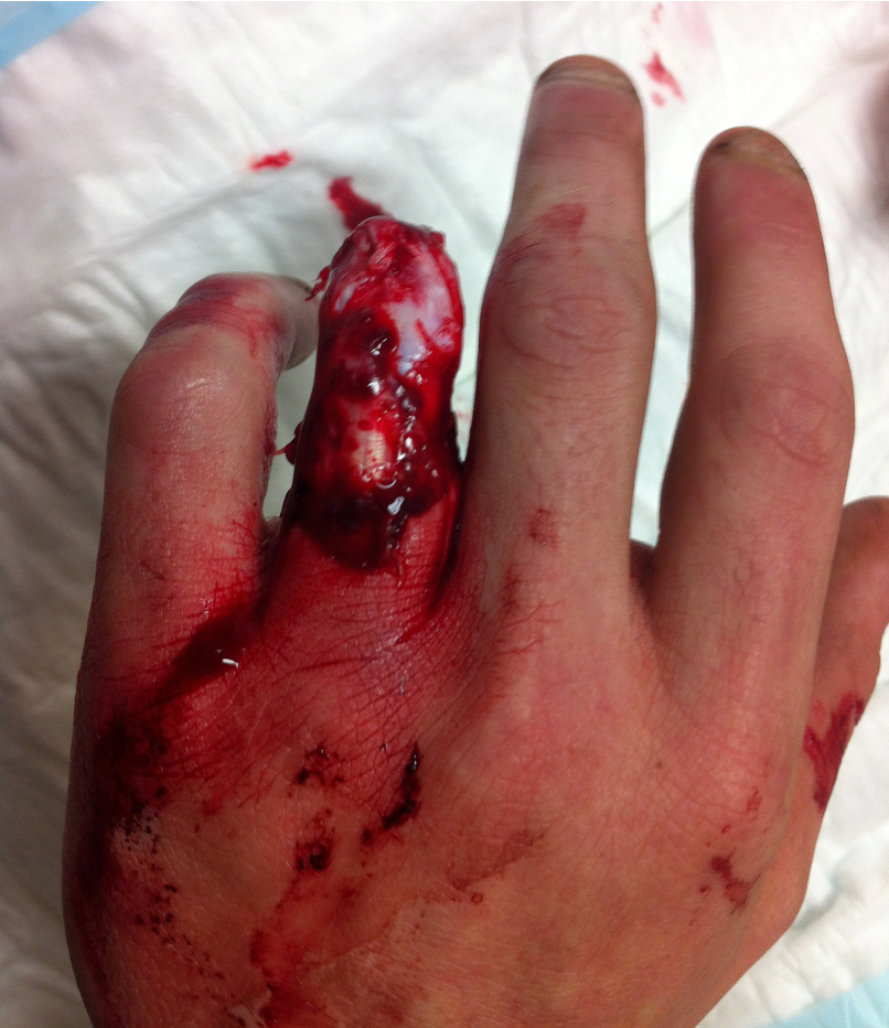 Finger avulsion 1