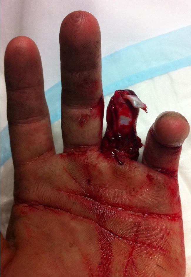 Ring avulsion 2