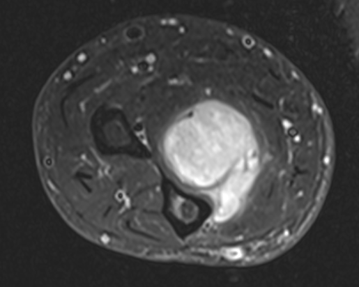 Forearm sarcoma