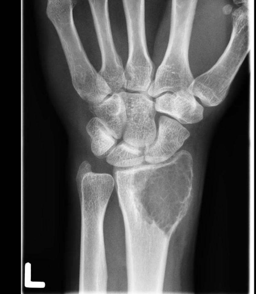 GCT distal radius