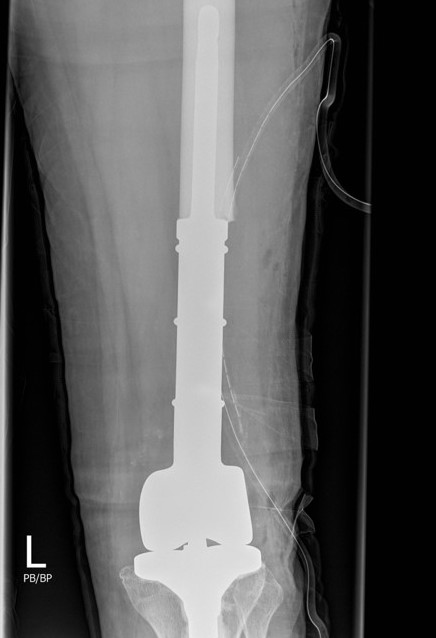 GCT femur 3