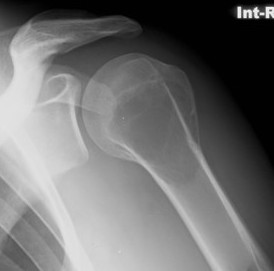 GCT humerus