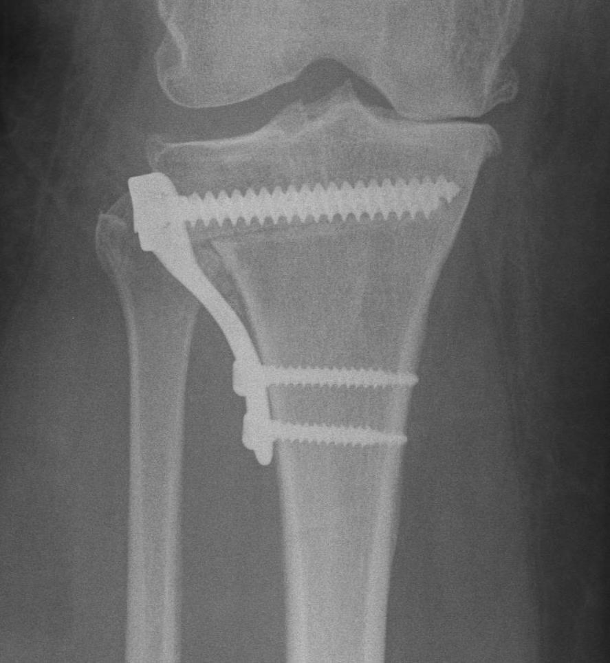 lateral closing HTO