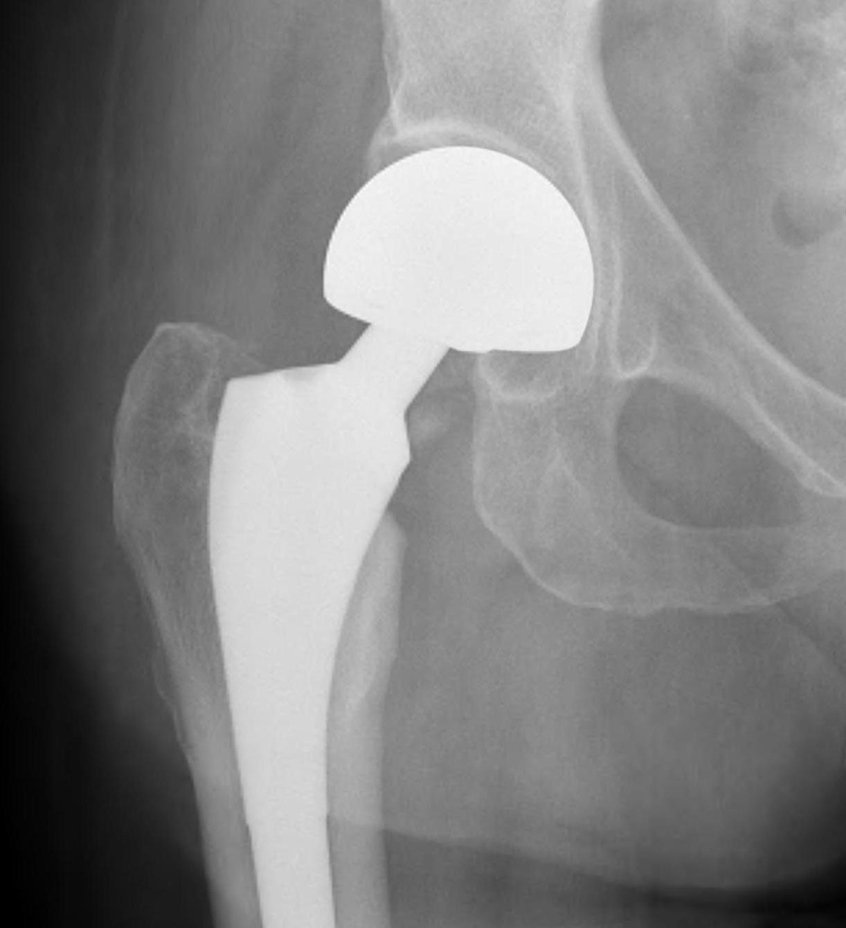 Uncemented hip