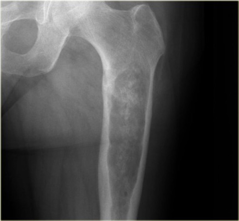 Hip chondrosarcoma xray