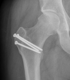 HIp PVNS dislocation