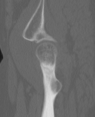 Hip stress CT