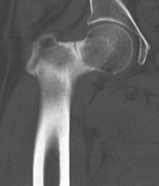 Superior hip stress fracture