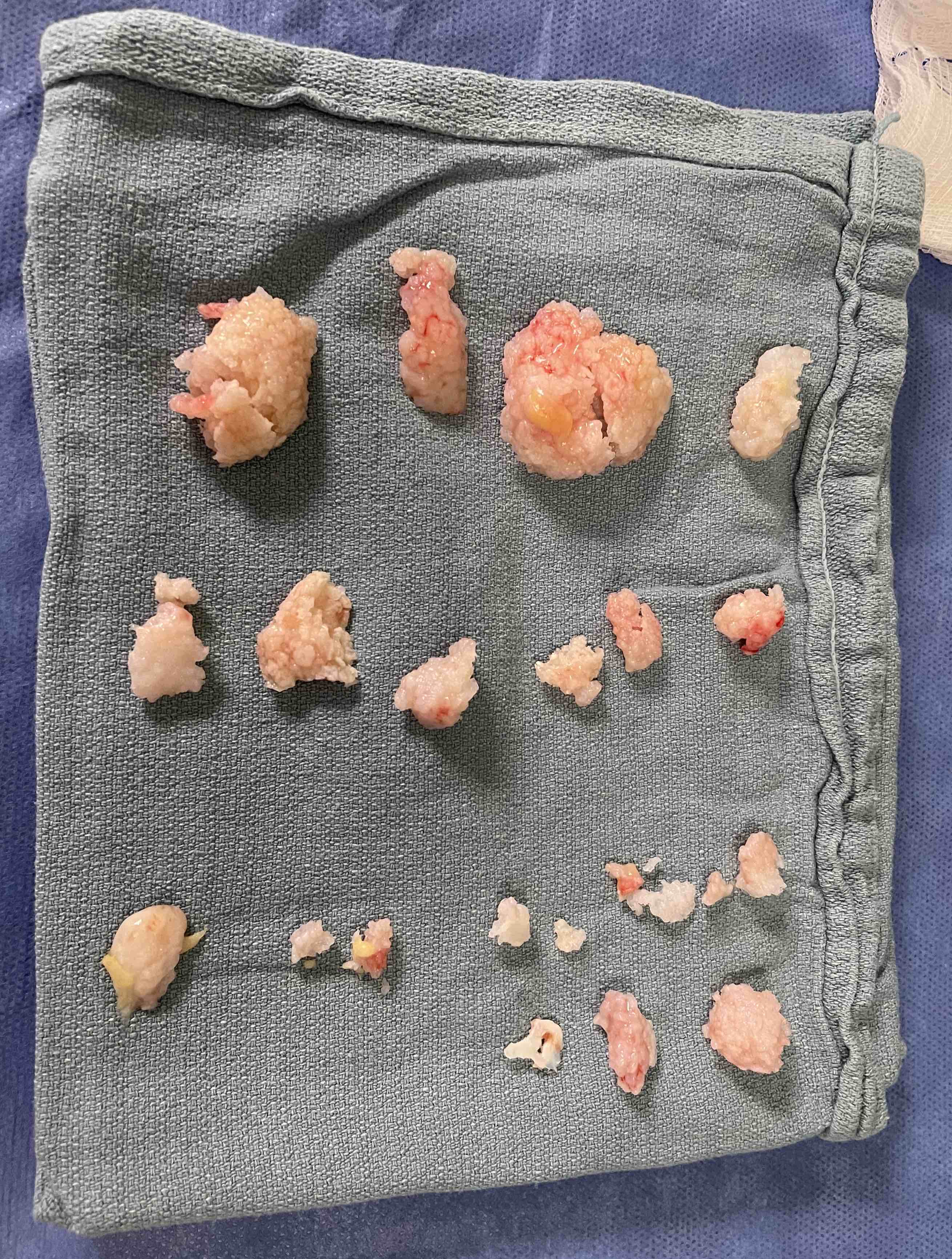 Synovial osteochondromatosis