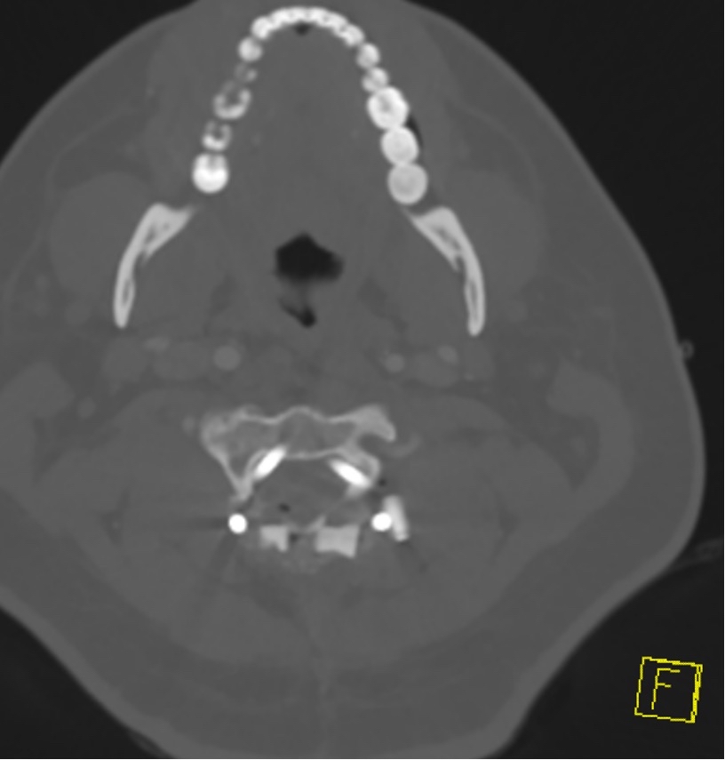 Occ condyle Type II