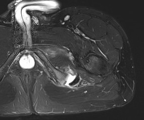 Ischial tuberosity avulsion 2