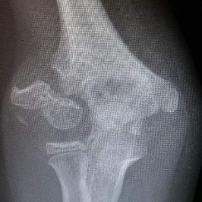 Lateral condyle nonunion