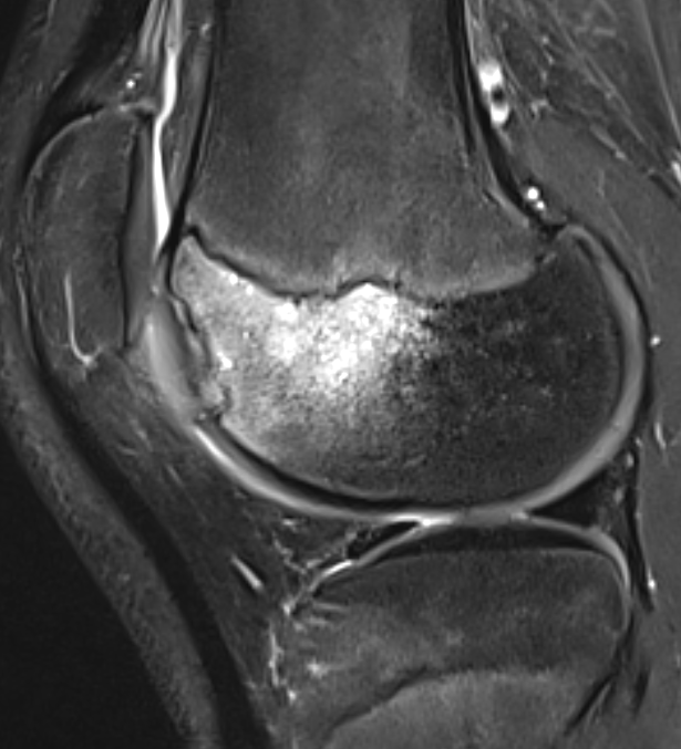 Unstable trochlea OCD with cartilage cleft