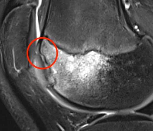 Trochlea OCD cartilage cleft