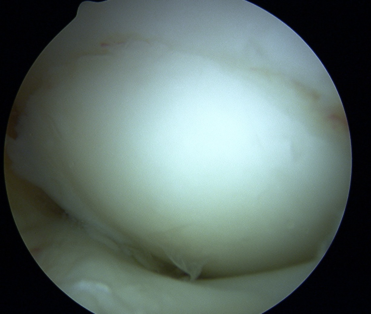 Lateral femoral OCD