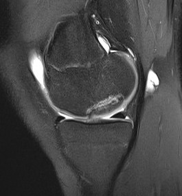 Loose OCD MFC MRI