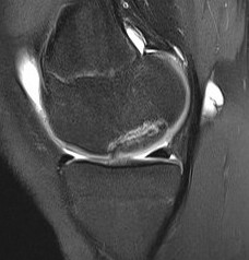 Unstable OCD MRI