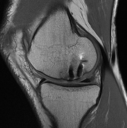 MRI OCD Healing 2