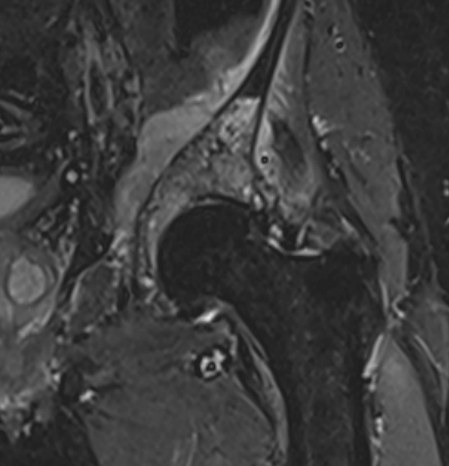 Pelvic CS MRI