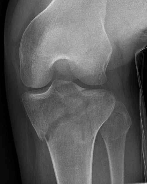 Tibial plateau Type IV