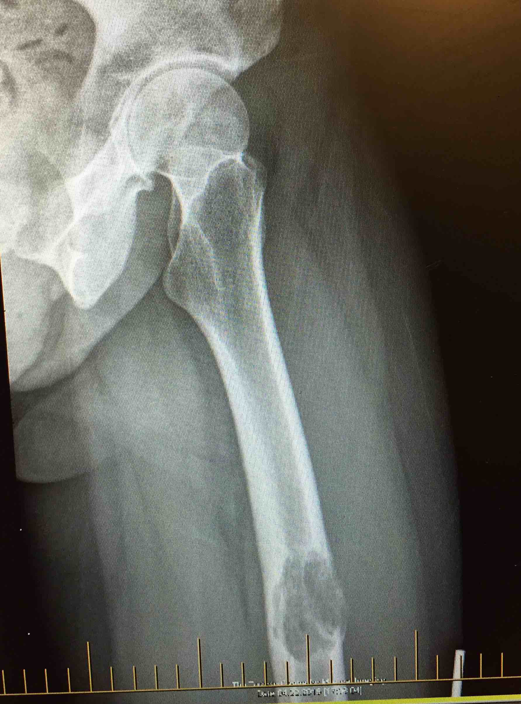 Femur met 1