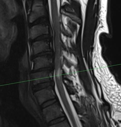 Cervical cord damage