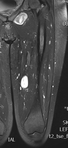 Neurofibroma 1