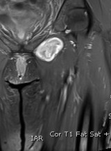 Neurofibroma 3