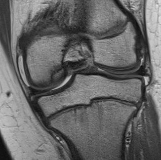 Stage 1 OCD MRI