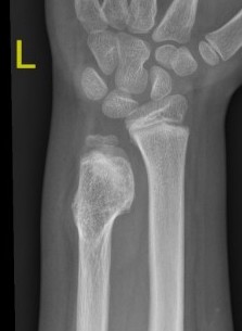 Osteochondroma Ulna