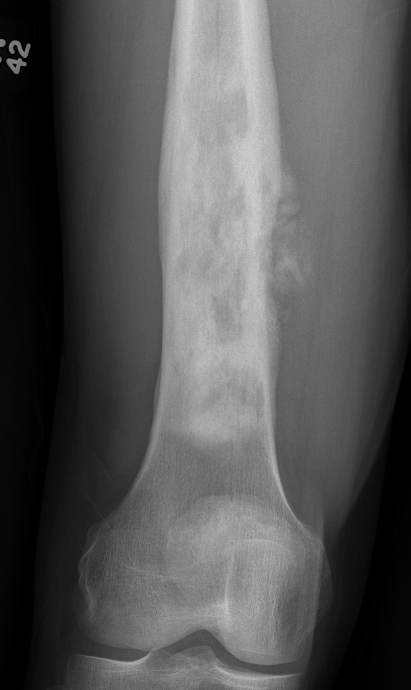 OS femur 1