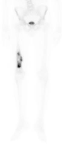 OS femur bone scan