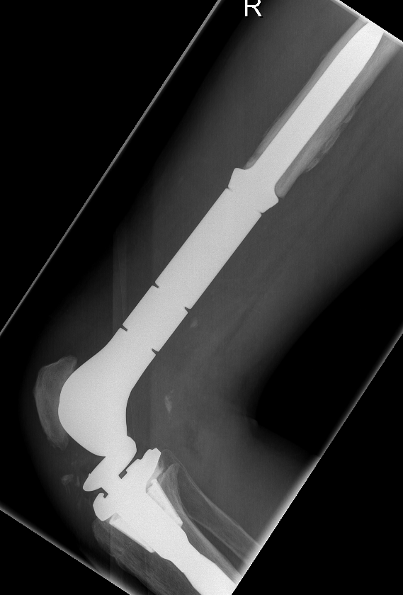 Femoral megaprosthesis 2