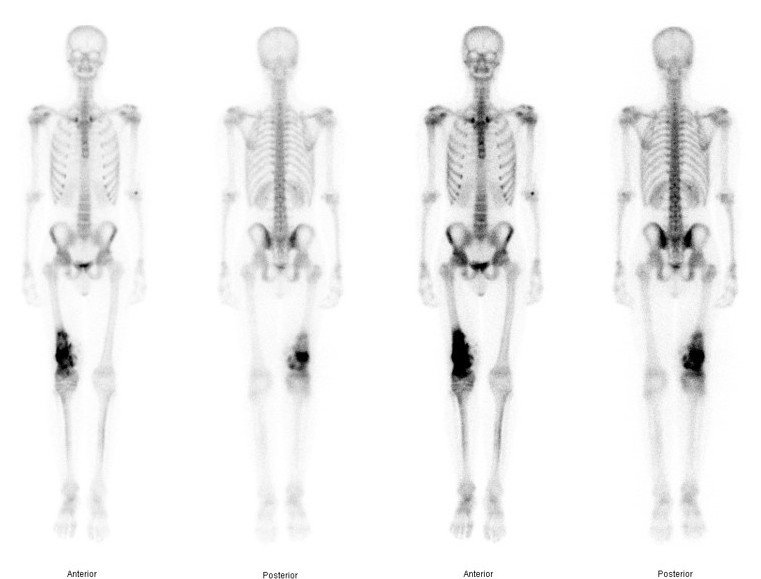 OS bone scan