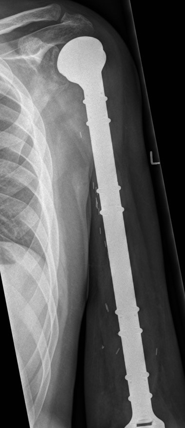 Humerus Megaprosthesis 1