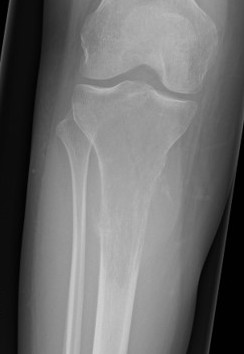 Osteosarcoma tibia