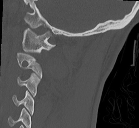 Occipito atlanto dislocation