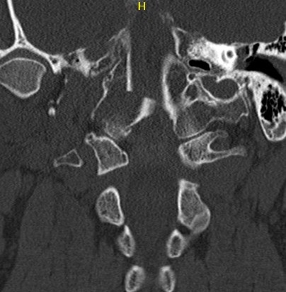 Occ condyle Type II