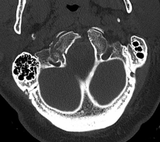 Occ condyle Type II 