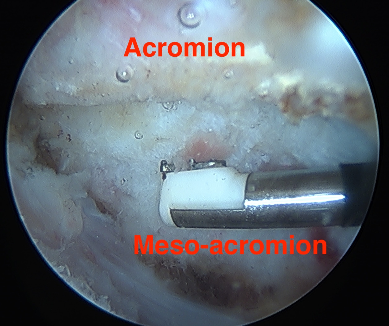 Os acromiale arthroscopic