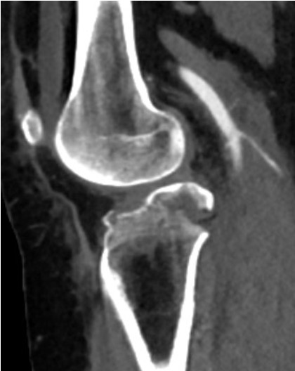 PCL bony avulsion