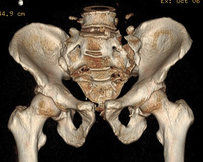 Pelvic fracture APC