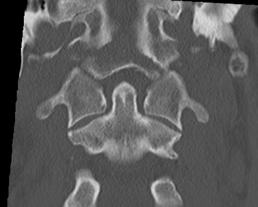 Type II occipital condyle