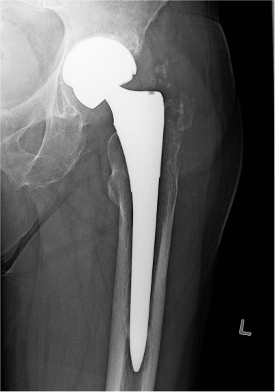 Metallosis xray