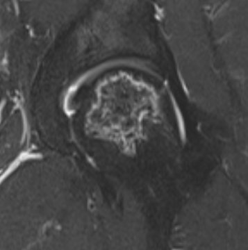 Hip AVN MRI