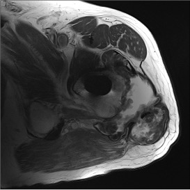 Metallosis MRI 2