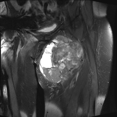 Pleomorphic sarcoma 1