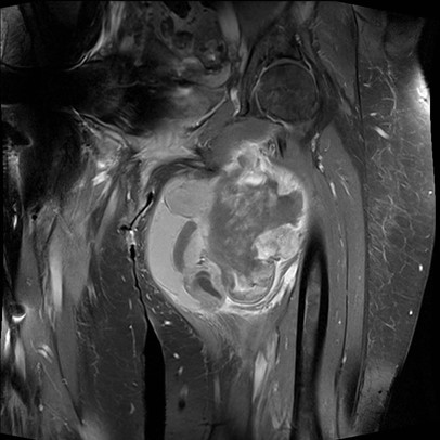 Sarcoma thigh 1