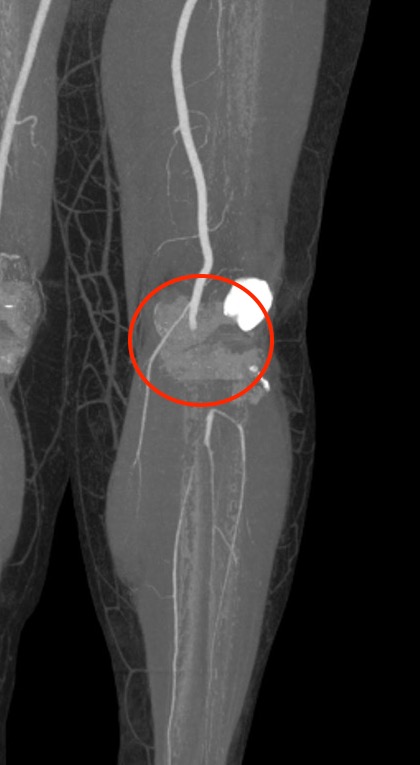 Popliteal artery transection 2