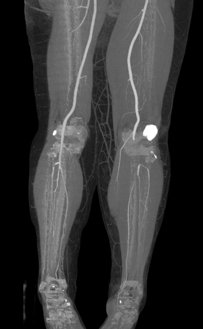 Popliteal artery transection 1